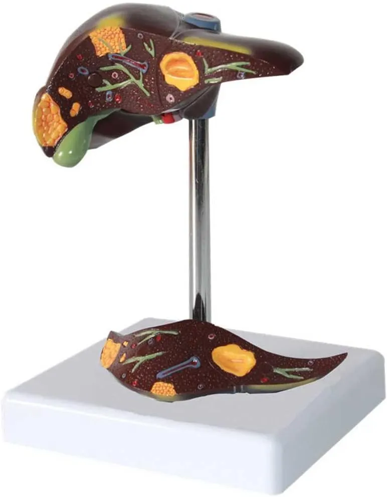 and 2 Detachable Parts for Learning and Understanding The S Teaching Model,Liver conscientious Pathology Teaching Model 1:1 Human Liver Anatomy Model with Clear Texture and Pathological Features 