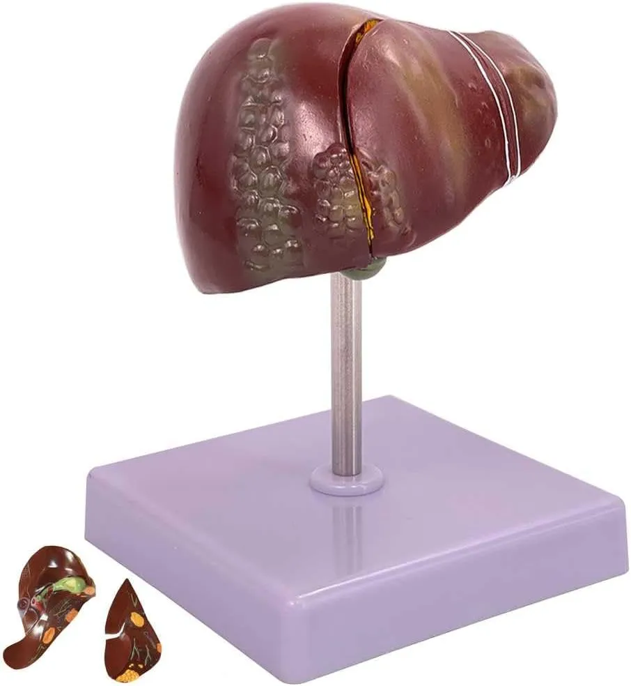 hiccup chronology readily systematic coconut relaxation and 2 Detachable Parts for Teaching De Teaching Model,Liver Pathology Educational Model Life Size Human Liver Gallbladder Anatomy Model with Clear Texture and Pathological Features 
